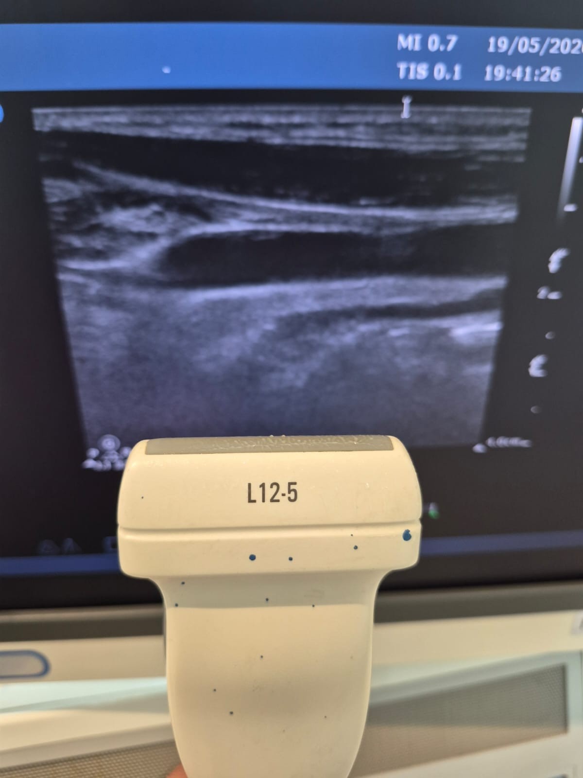 Philips L12-5 Linear Array Ultrasound Transducer Probe